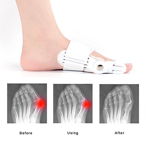 Bonny Orthosis, Hallux Valgus Orthosis se utiliza para diversos problemas causados ​​por el dedo del pie en valgo