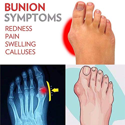 SQL Férulas ortopédicas Damas Zapatillas, Sandalias Planas Dedo Gordo del Verano Mujeres Hallux Valgus Ortopédica Flip Flops cómodo para el Tratamiento,Negro,41