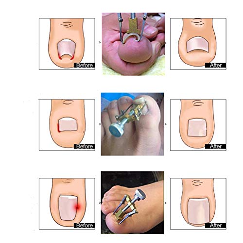 BUYGOO Uñas Encarnadas Corrector Cura Sin Dolor Sano Paroniquia Herramientas para Clavo Tratamiento para Defecto de Crecimiento de Uñas Paronychia Ingrown Toenail Oro