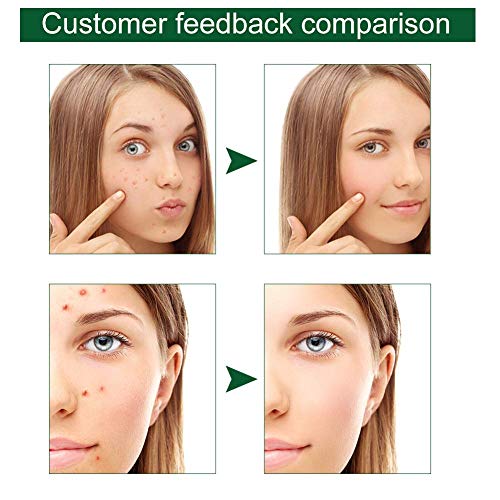 Crema Acne,Acne Tratamiento,Crema de Hierbas para el acné,Reducir los Puntos negros, Equilibrar el Agua y el Aceite, la Crema Contra el Acné Espinilla, Regenera la piel