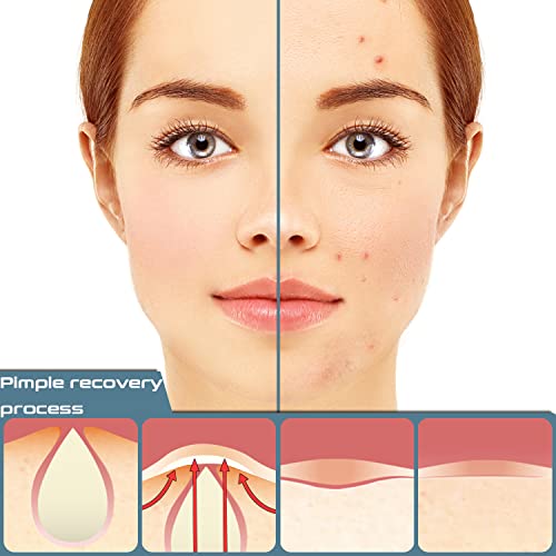216 PCS Parches Para Acné, Uso Diurno y Nocturno Parches Acne 2 en 1, Parches Para Espinillas Hidrocoloides Eficaces e Invisibles, Impermeable y Transpirable Parches Absorbentes Parches de Acné