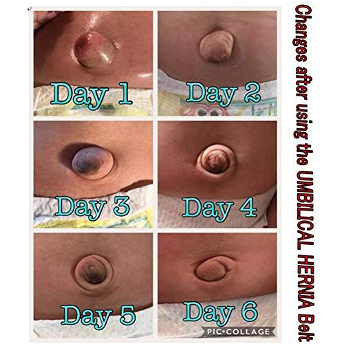 Cinturón de Hernia de bebé, Cinturón de Hernia Umbilical Envoltura Ajustable médica Hernia de Ombligo Braguero Cinturón-Botón Banda Soporte Banda de Vientre,A
