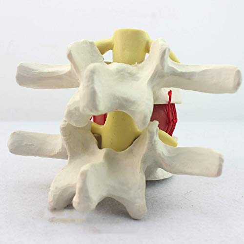 ZHANGYY Modelo de Hernia de Disco Lumbar Humano, Modelo anatómico de Hernia de Disco de vértebras lumbares humanas, Ayuda de demostración de compresión nerviosa para Disco abultado
