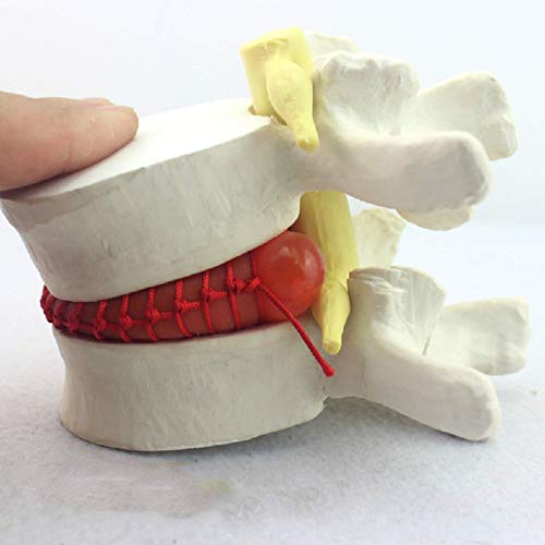 ZHANGYY Modelo de Hernia de Disco Lumbar Humano, Modelo anatómico de Hernia de Disco de vértebras lumbares humanas, Ayuda de demostración de compresión nerviosa para Disco abultado