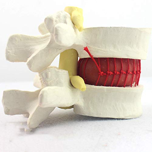 ZHANGYY Modelo de Hernia de Disco Lumbar Humano, Modelo anatómico de Hernia de Disco de vértebras lumbares humanas, Ayuda de demostración de compresión nerviosa para Disco abultado