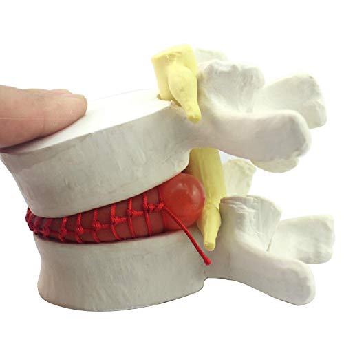 ZHANGYY Modelo de Hernia de Disco Lumbar Humano, Modelo anatómico de Hernia de Disco de vértebras lumbares humanas, Ayuda de demostración de compresión nerviosa para Disco abultado