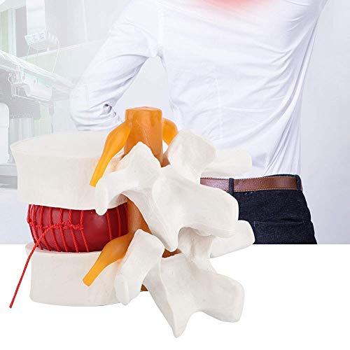 Anatomía humana, 1: 1.5 Modelo de demostración de hernia de disco lumbar humano del modelo de columna vertebral lumbar para demostración médica