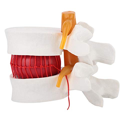 Anatomía humana, 1: 1.5 Modelo de demostración de hernia de disco lumbar humano del modelo de columna vertebral lumbar para demostración médica