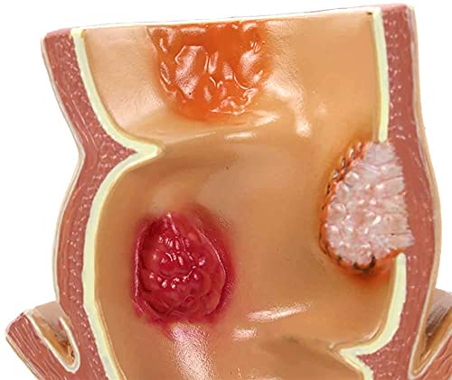 Modelo de anatomía, Modelo de lesión del acné del recto de la anatomía humana enfermedad patológica de la úlcera rectal del acné Modelo patológico para el modelo anatómico médico para demostración méd