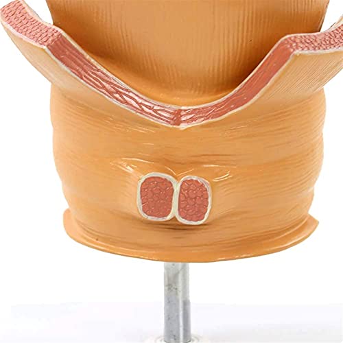 Modelo de anatomía, Modelo de lesión del acné del recto de la anatomía humana enfermedad patológica de la úlcera rectal del acné Modelo patológico para el modelo anatómico médico para demostración méd