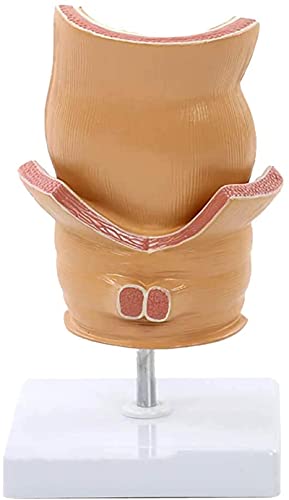 Modelo de anatomía, Modelo de lesión del acné del recto de la anatomía humana enfermedad patológica de la úlcera rectal del acné Modelo patológico para el modelo anatómico médico para demostración méd