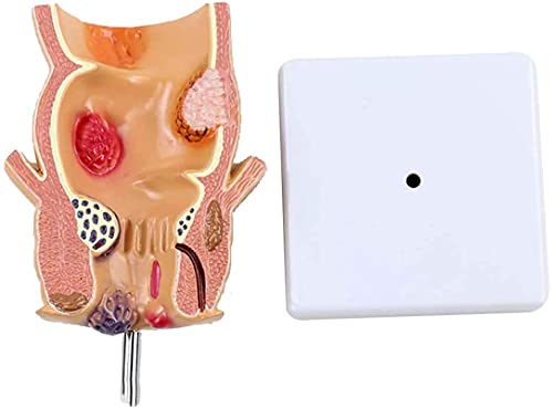 Modelo de anatomía, Modelo de lesión del acné del recto de la anatomía humana enfermedad patológica de la úlcera rectal del acné Modelo patológico para el modelo anatómico médico para demostración méd