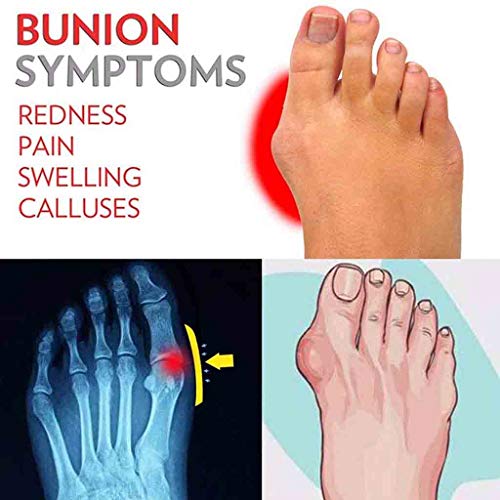 Mujeres Bunion Corrector Platform Sandal Comfy Casual Toe Correction Sandalias De Plataforma Juanete Corrector Ortesis Sandalias del Dedo del,Oro,36