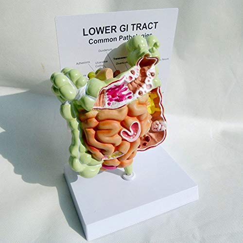 ZYYH Modelo de lesión colorrectal Humana, Modelo del tracto gastrointestinal, réplica de la anatomía del Cuerpo Humano del Sistema digestivo para médicos, Herramienta educativa de Oficina.