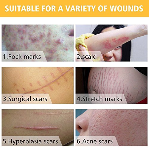 SkinRosa Crema para eliminar eficazmente el acné y las cicatrices como quemaduras, cortes, marcas de estiramiento de embarazo, manchas de acné, Elimina las cicatrices nuevas y antiguas