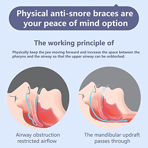 Sonoaud Guardia de dientes Cómodo sueño mejor respiración Ayuda Apnea Stooper Alta calidad Azul