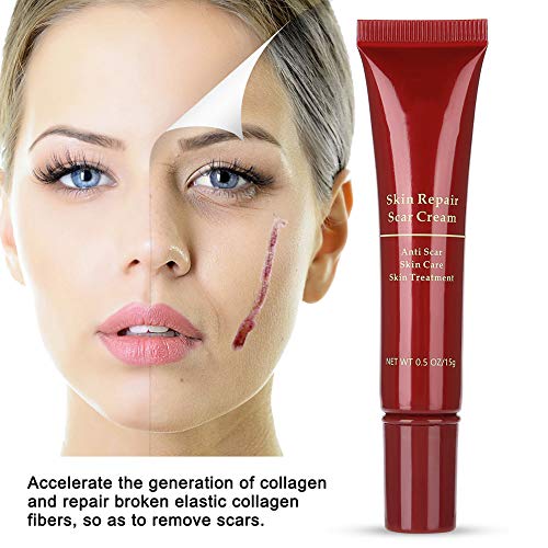 Crema para eliminar cicatrices del acné, reparación de la piel, para la cara, manchas para el acné, crema para blanquear puntos negros, crema antiestrías