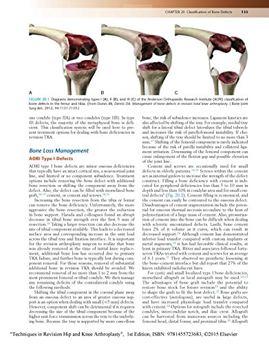 Techniques in Revision Hip and Knee Arthroplasty, 1e