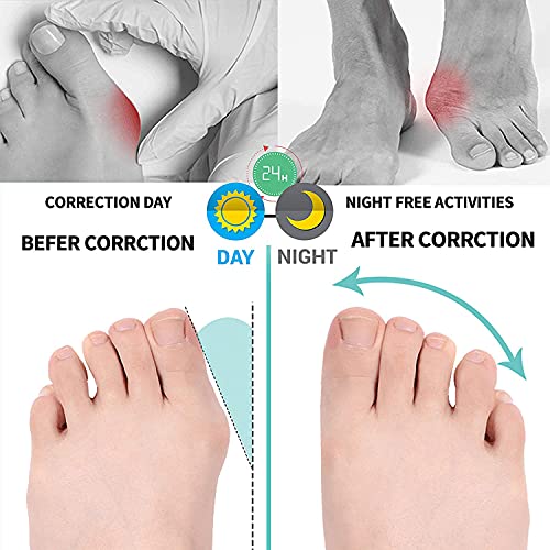 Whooo Corrector De Juanetes para Noche y Día,8 Correctores de Gel Para el Dedo Gordo del Pie, almohadillas de juanetes, férula de bici, botie, protector, Protección de Juanetes y Hallux