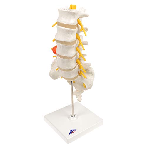 3B Scientific A76/5 Modelo de anatomía humana Columna Vertebral Lumbar Con Hernia Discal Dorso lateral + software de anatomía gratuito - 3B Smart Anatomy