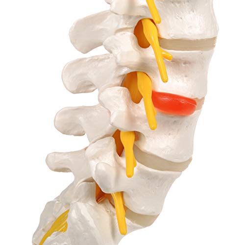 3B Scientific A76/5 Modelo de anatomía humana Columna Vertebral Lumbar Con Hernia Discal Dorso lateral + software de anatomía gratuito - 3B Smart Anatomy