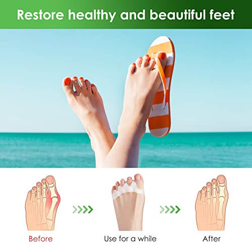 4 Par Separador Dedos Pie, Gullnest Corrector para Dedos Toe Hallux Valgus, 0% BPA Silicona Gel Mejorada, un Tamaño Adecuado para todos, hallux valgus