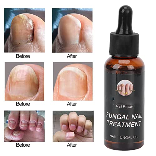 Aceite para el Cuidado de las Uñas, Tratamiento de Reparación de Uñas Suave 50 Ml para el Hogar para el Engrosamiento de las Uñas