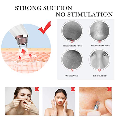Coriver Aspirador removedor de espinillas, limpiador facial de 5 piezas, herramienta limpiadora de comedones para acné, 6 cabezales de succión, limpiador eléctrico para puntos de poros