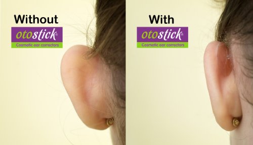 Corrección instantánea para orejas prominentes de Otostick, 3 paquetes