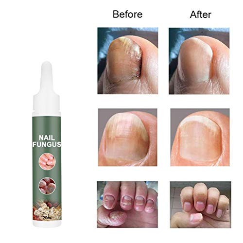 Crema de hongos para uñas, crema para onicomicosis, engrosamiento de uñas para manos y pies, suavizar el cuidado de las uñas, crema para el cuidado de la piel, tratamiento para hongos en las uñas