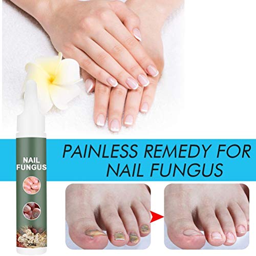 Crema de hongos para uñas, crema para onicomicosis, engrosamiento de uñas para manos y pies, suavizar el cuidado de las uñas, crema para el cuidado de la piel, tratamiento para hongos en las uñas