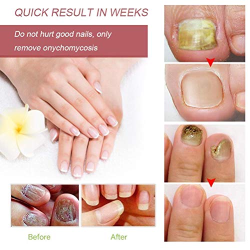 Crema de hongos para uñas, crema para onicomicosis, engrosamiento de uñas para manos y pies, suavizar el cuidado de las uñas, crema para el cuidado de la piel, tratamiento para hongos en las uñas
