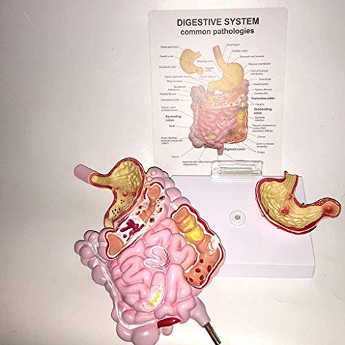 DIELUNY Paradigma pedagógico Intestino Grueso Úlcera de estómago Cúbito Patología patológica Modelo anatómico - Modelo de órgano Modelo del Sistema digestivo Humano PVC Humano