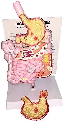 DIELUNY Paradigma pedagógico Intestino Grueso Úlcera de estómago Cúbito Patología patológica Modelo anatómico - Modelo de órgano Modelo del Sistema digestivo Humano PVC Humano