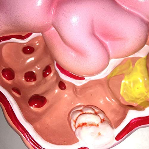 DIELUNY Paradigma pedagógico Intestino Grueso Úlcera de estómago Cúbito Patología patológica Modelo anatómico - Modelo de órgano Modelo del Sistema digestivo Humano PVC Humano