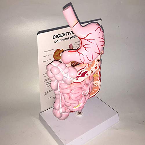 FGA Modelo Educativo Intestino Grueso Cúbito Úlcera estomacal Patología gástrica patológica Modelo anatómico - Modelo de órgano Humano Modelo de Sistema digestivo Humano de PVC