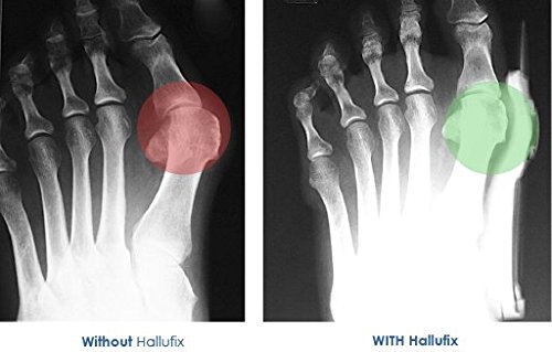 Homecraft Hallufix - Soporte para juanetes