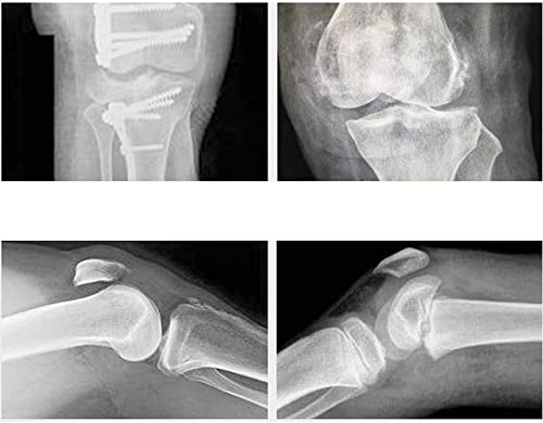 Inmovilizador De Rodilla, Soporte Completo Para Piernas, Banda De Rodilla Transpirable, Férula Universal Para Rodilla, Adecuada Para La Recuperación De La Cirugía Y Después De La Operación De Rodilla