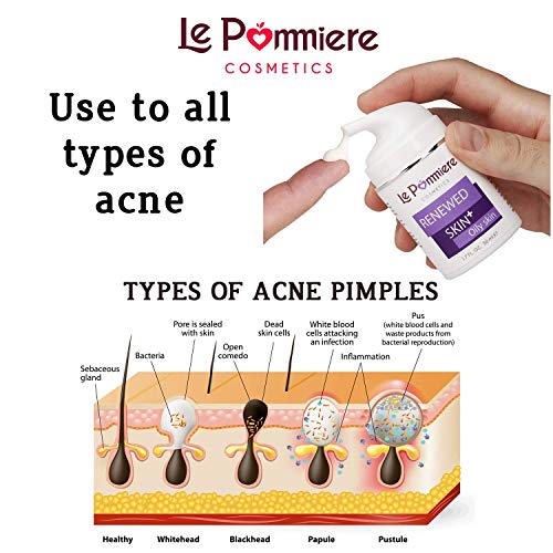 Le Pommiere Tratamiento Acné gel 50ml. Ayuda a remover espinillas, granos en cara o cuerpo. Anti imperfecciones facial y corporal. Adolescente, juvenil, hormonal o quístico