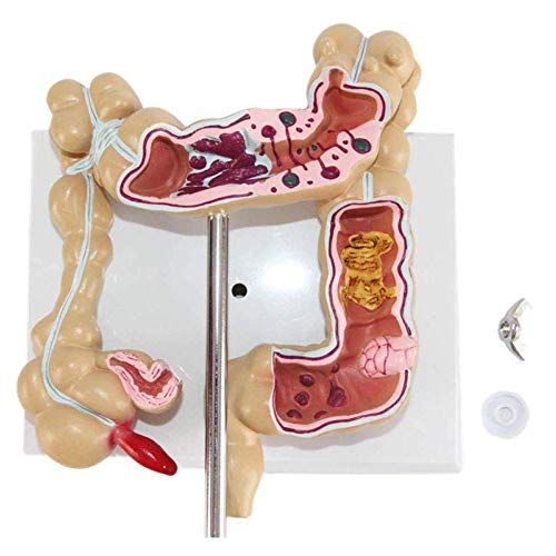 Modelo patológico de colon humano, modelo de lesión colorrectal de colon humano, modelo de enfermedad patológica del intestino grueso, modelo de lesión colorrectal para material didáctico de educació