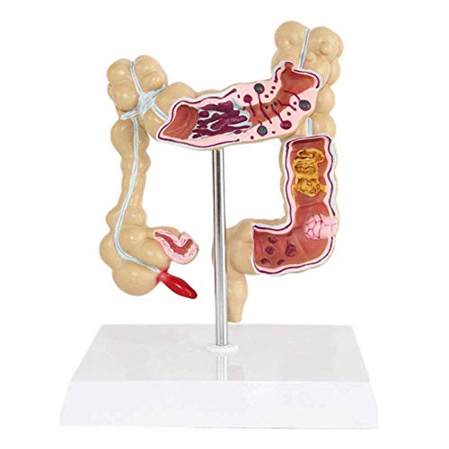 Modelo patológico de colon humano, modelo de lesión colorrectal de colon humano, modelo de enfermedad patológica del intestino grueso, modelo de lesión colorrectal para material didáctico de educació