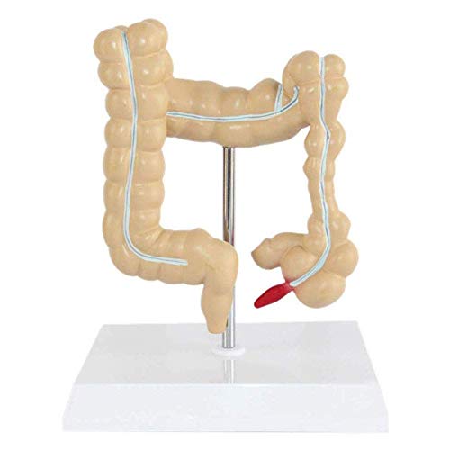 Modelo patológico de colon humano, modelo de lesión colorrectal de colon humano, modelo de enfermedad patológica del intestino grueso, modelo de lesión colorrectal para material didáctico de educació