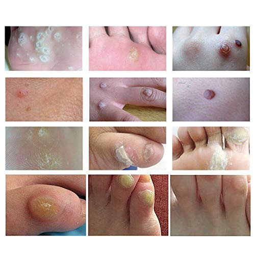 Removedor de verrugas, verrugas, puede eliminar verrugas plantares y comunes, verrugas de raíz congelada, removedor de verrugas para pies y manos
