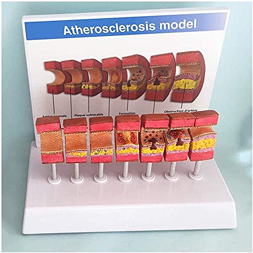 QULONG Modelo de ensamblaje Modelo anatómico de la arteria Aterosclerosis Modelo de Vaso de trombo de la arteria Humana para los Estudios Modelo de exhibición de enseñanza, con descripción en inglé